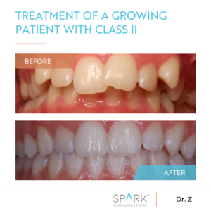 Teeth Before and After Spark Clear Aligners